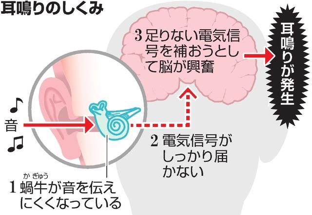 専門家が推奨する耳鳴り軽減エクササイズ