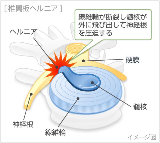 腰痛を緩和するための日常生活で取り入れやすいエクササイズ